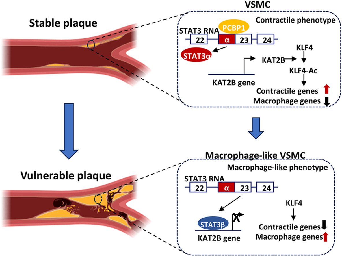 Atherosclerosis (@athjournal) on Twitter photo These findings provide insights into the role of STAT3β isoforms in plaque stability and the phenotypic flexibility of VSMCs, highlighting potential targets for therapeutic intervention in atherosclerosis
🔗atherosclerosis-journal.com/article/S0021-…
<a href="/society_eas/">European Atherosclerosis Society</a> @ELS_Cardiology #EASSoMe These findings provide insights into the role of STAT3β isoforms in plaque stability and the phenotypic flexibility of VSMCs, highlighting potential targets for therapeutic intervention in atherosclerosis
🔗atherosclerosis-journal.com/article/S0021-…
<a href="/society_eas/">European Atherosclerosis Society</a> @ELS_Cardiology #EASSoMe