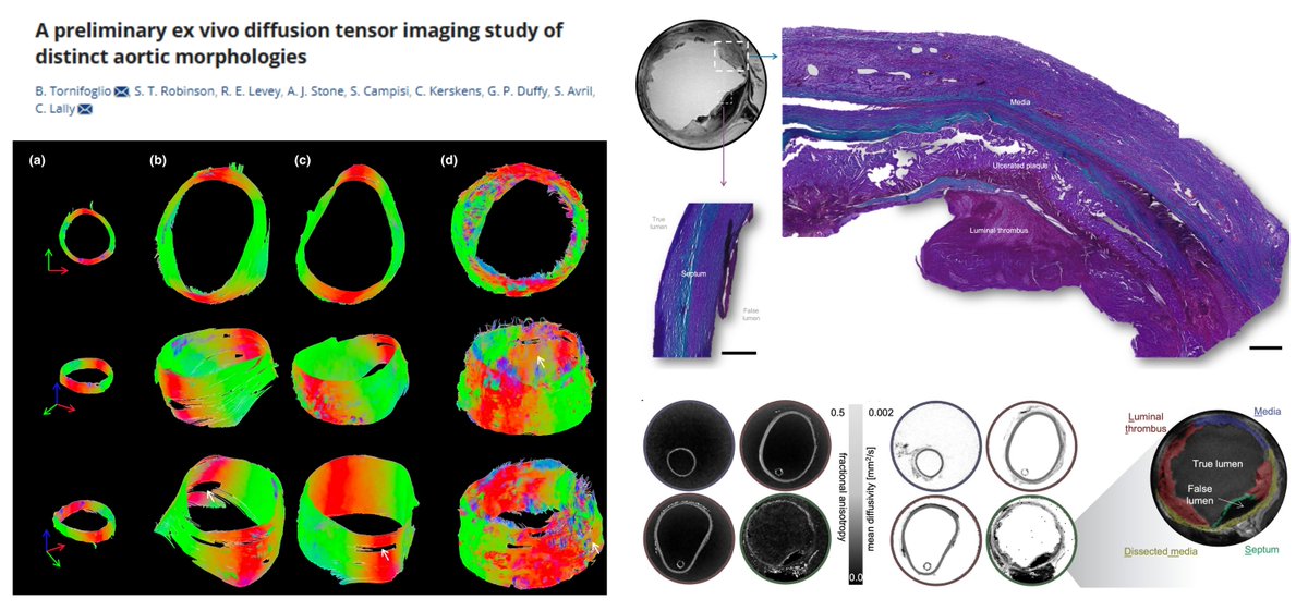 HaoYin20's tweet image. Aorta Tractography via #DiffusionTensorImaging #DTI
2 #AorticAneurysm
1 #AorticDissection
1 Control
In chronic type B AD
Dissected aortic media have even lower Fractional Anisotropy (▶️structural alignment) than luminal thrombus, false lumen septum & intact media! 🥸
#AortaEd…
