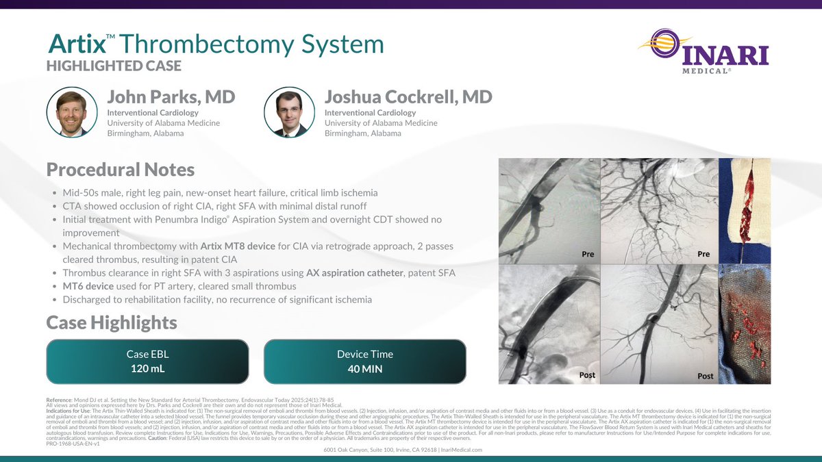 Inari Medical (@inarimedical) on Twitter photo Check out this Artix case featured in Endovascular Today by Drs. John Park and <a href="/cockrell_josh/">Josh Cockrell</a>.
#Artix is the all-in-one solution for arterial #clot treatment, offering:
- 40-minute device time
- Mechanical thrombectomy and aspiration
- No recurrence of significant ischemia Check out this Artix case featured in Endovascular Today by Drs. John Park and <a href="/cockrell_josh/">Josh Cockrell</a>.
#Artix is the all-in-one solution for arterial #clot treatment, offering:
- 40-minute device time
- Mechanical thrombectomy and aspiration
- No recurrence of significant ischemia