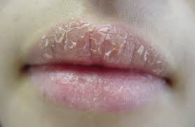 UGM_FESS's tweet photo. Help guys, ada yang suka jilat-jilat bibir atau ngopekin bibir sampe jadi kering atau berdarah gitu ga ya? Rep ajaa🥺🙏🏼 https://t.co/MJ1XjC3ziZ