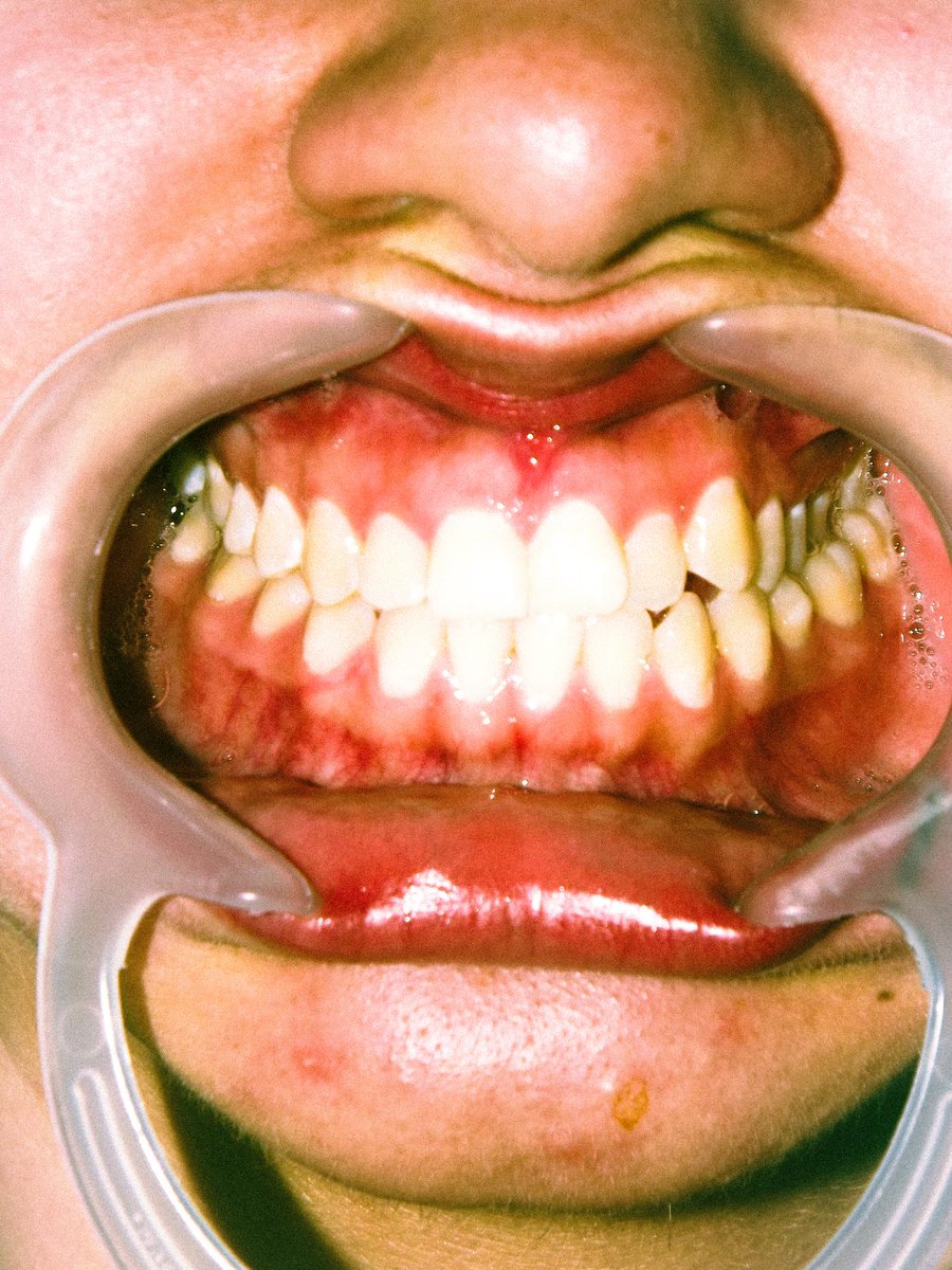 anfetaa's tweet photo. Fijación Dental https://t.co/WqC7OLLIKC