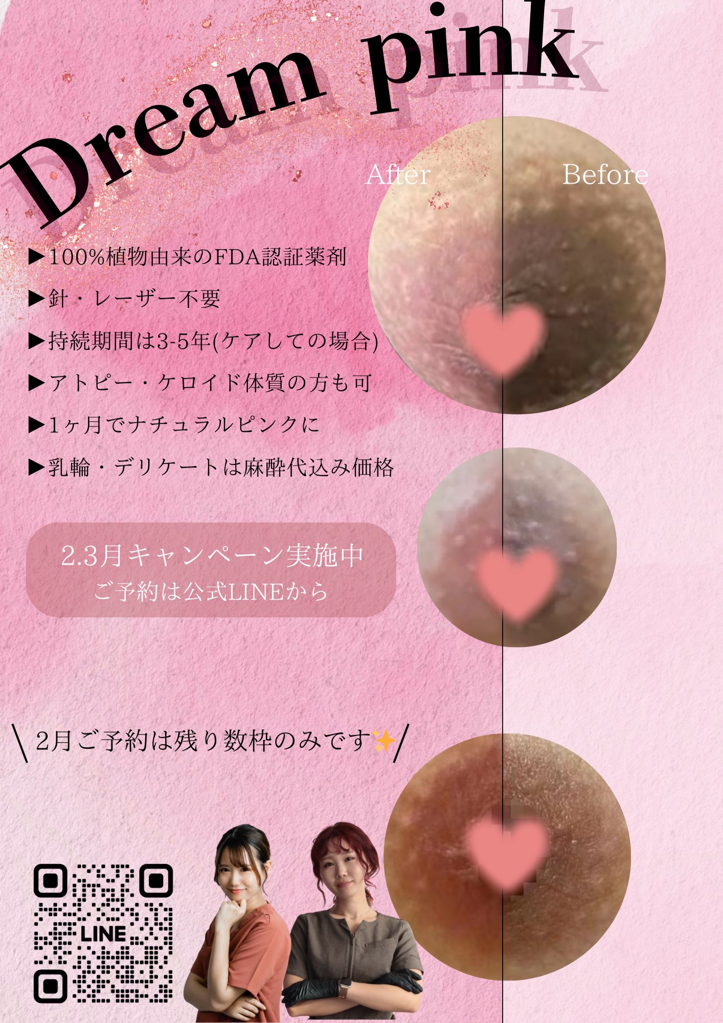 乳輪　ピンク 本当に効果すごい🥹❣️ 私も乳輪 乳頭施術していますがアフターケアクリーム塗る前からもうすでにうっすらピンクに🎀 アフターケアクリームを塗り始めたらもっとピンクになるので楽しみです✨  ぜひ黒ずみ気になってる方は ...