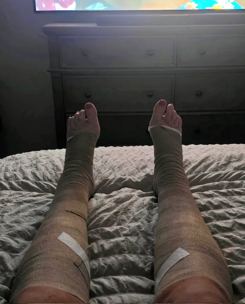 Stitches out today. Clear margins from surgery last Tues. on the breast, but now for the weirdest chemo treatment. 3-days, once a mo. for 3- mo. These chemo wraps 🔥 should take care of these cancer tattered legs. Difficult but worth it. 💞 #checkyourselfbeforeyouwreckyoursef