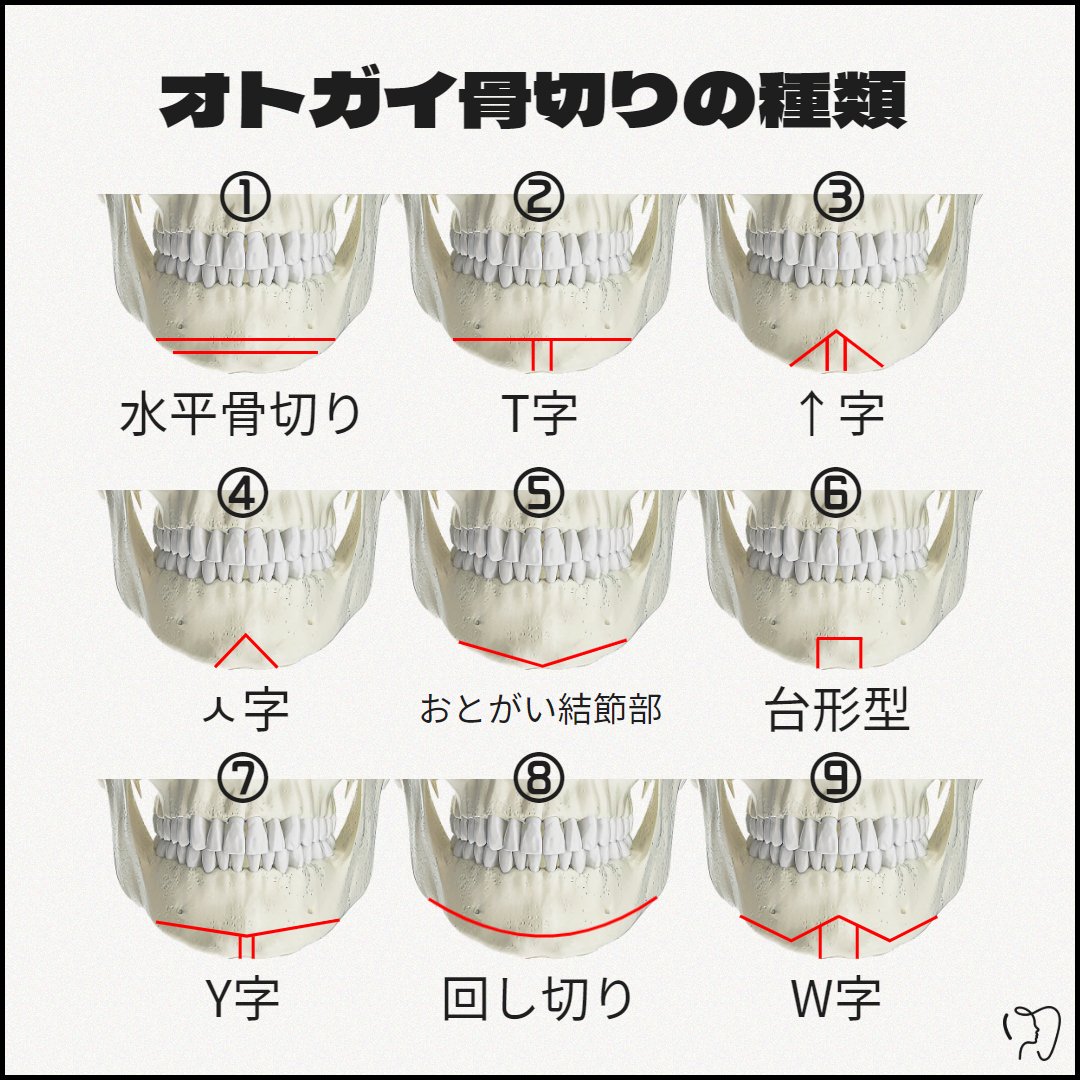 MACSJPPS's tweet photo. オトガイ形成をされるにあたり
顎先をどう手術すればいいのか迷われている方も多いですよね。

頬、エラ、顎先の中でも術式が最も多いのが ”顎先”
カウンセリングを受けられる際にどの切骨方法が自分の好みの顎先になるのか、またトータルバランスとして自分のイメージに合うのかなど専門医との精密な相談が必要です。

【 オトガイ適応切骨術 】
顎が長い人　①⑥⑦
顎が大きい　①②③⑥⑧
顎の幅が広い人　②③⑥⑦
顎なし　①④
しゃくれ顎　①③④
割れ顎　⑤⑧
非対称　①⑧⑨

※上記は一般的な判断方法を目安に記載していますので
必ずこの術式のみが適応という意味ではありません。

#オトガイ形成 #輪郭3点 #両顎手術