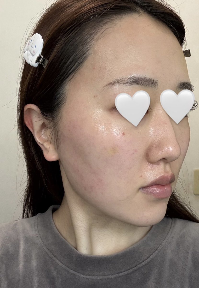 プランエスクリニック(@plansjp ) フルフェイスのペッ注射から1週間