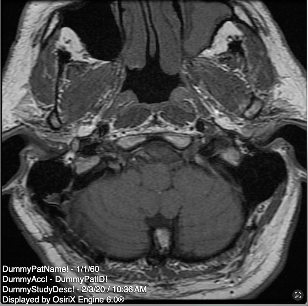 Burçe (@burceozgen) on Twitter photo How do you save anonymized DICOM images on GEPACS? All images have by default "dummy" header & the solution they offer is to manually edit every single info (26 different slots that needs to be edited for every single sequence separately). <a href="/GEHealthCare/">GE HealthCare</a> #PACS #radiology How do you save anonymized DICOM images on GEPACS? All images have by default "dummy" header & the solution they offer is to manually edit every single info (26 different slots that needs to be edited for every single sequence separately). <a href="/GEHealthCare/">GE HealthCare</a> #PACS #radiology