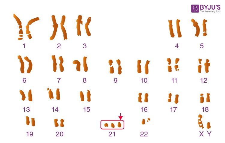 ninja_smle's tweet photo. In Down syndrome, there is an additional copy of chromosome 21, resulting in three copies instead of the usual two copies. Down syndrome is a genetic condition caused when an unusual cell division results in an extra full or partial copy of chromosome 21 https://t.co/OFRWq5wpav