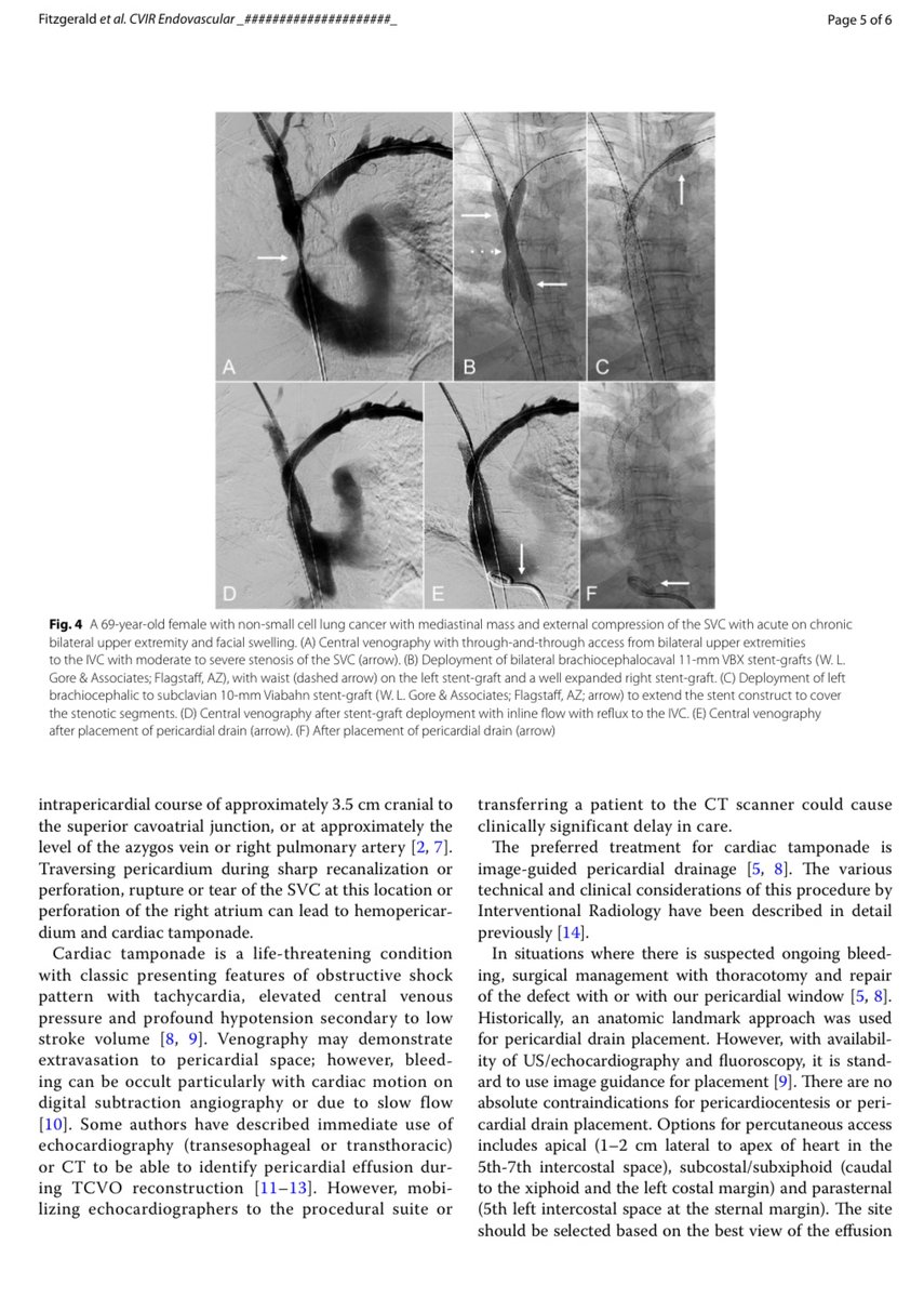 Jeffrey F. B. Chick, MD, MPH (@chickvir) on Twitter photo Echocardiographic monitoring during thoracic central venous obstruction reconstruction may aid in early diagnosis and management of cardiac tamponade.
<a href="/cvirendo/">CVIR Endovascular (Jim Reekers, Editor-in-Chief)</a> <a href="/CVIR_Journal/">CVIR Journal</a> <a href="/JVIRmedia/">JVIR</a> <a href="/VenousNews/">Venous News</a> <a href="/EVToday/">Endovascular Today</a> <a href="/SIRspecialists/">Society of Interventional Radiology</a> <a href="/USCRadResearch/">Radiology Research of USC</a> <a href="/UWRadiology/">UW Radiology</a> Echocardiographic monitoring during thoracic central venous obstruction reconstruction may aid in early diagnosis and management of cardiac tamponade.
<a href="/cvirendo/">CVIR Endovascular (Jim Reekers, Editor-in-Chief)</a> <a href="/CVIR_Journal/">CVIR Journal</a> <a href="/JVIRmedia/">JVIR</a> <a href="/VenousNews/">Venous News</a> <a href="/EVToday/">Endovascular Today</a> <a href="/SIRspecialists/">Society of Interventional Radiology</a> <a href="/USCRadResearch/">Radiology Research of USC</a> <a href="/UWRadiology/">UW Radiology</a>