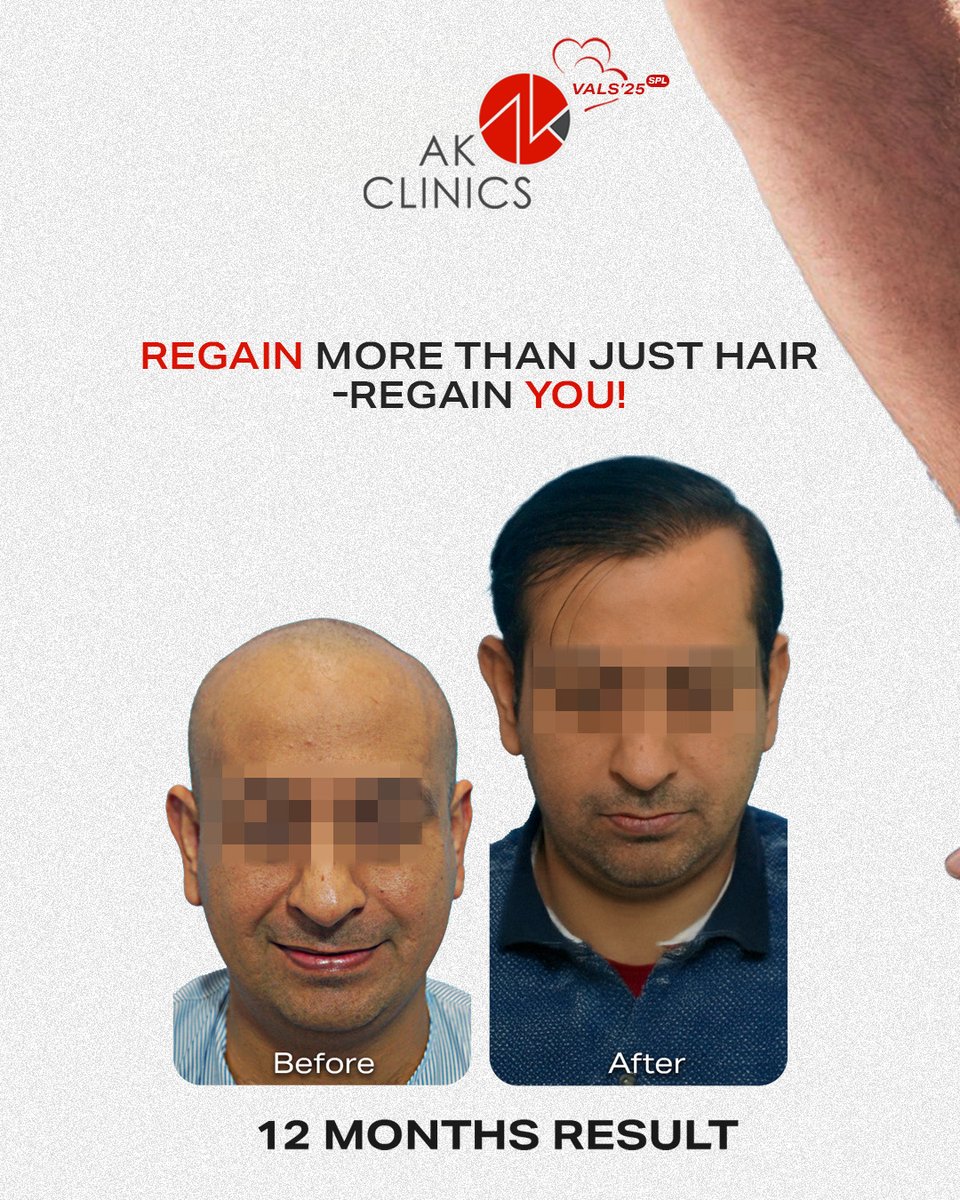 AKClinics's tweet photo. Hair Rejuvenation Treatment 🌟 Get 50% OFF this February!
Regain your hair and confidence with AK Clinics 

✨ 50% OFF this Valentine’s season! ✨
Because self-love starts with self-care! 💡”

📩 DM us or call 📞 +91-97799-44207 to book your consultation today! https://t.co/qEmVl7zyUg
