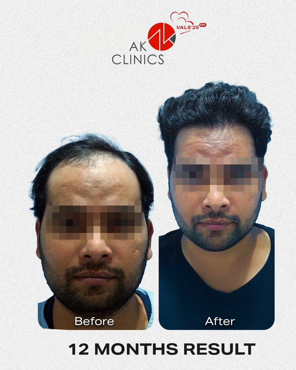 AKClinics's tweet photo. Hair Rejuvenation Treatment 🌟 Get 50% OFF this February!
Regain your hair and confidence with AK Clinics 

✨ 50% OFF this Valentine’s season! ✨
Because self-love starts with self-care! 💡”

📩 DM us or call 📞 +91-97799-44207 to book your consultation today! https://t.co/qEmVl7zyUg