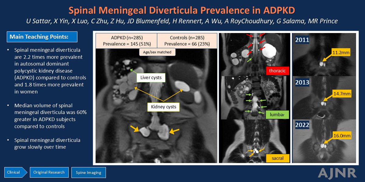 TheAJNR's tweet photo. "Prevalence of Spinal Meningeal Diverticula in Autosomal Dominant Polycystic Kidney Disease"

https://t.co/IPq0E909l2

@Its_usamaMD https://t.co/Izb6MSE4w7