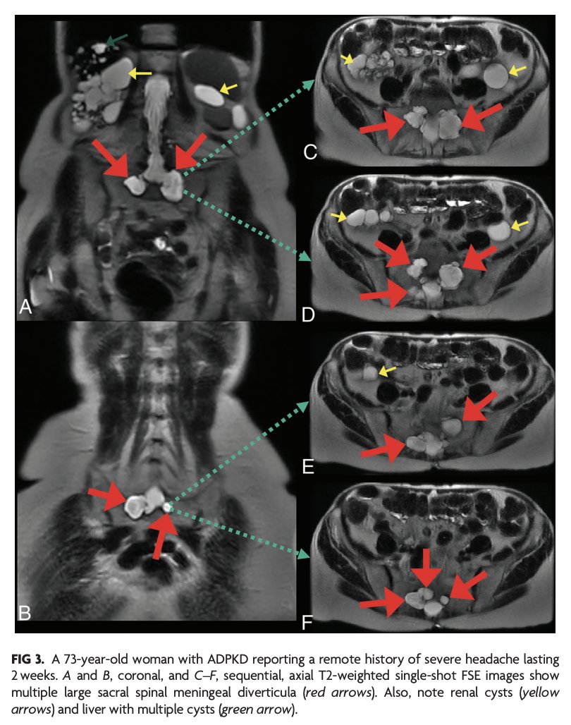 TheAJNR's tweet photo. "Prevalence of Spinal Meningeal Diverticula in Autosomal Dominant Polycystic Kidney Disease"

https://t.co/IPq0E909l2

@Its_usamaMD https://t.co/Izb6MSE4w7
