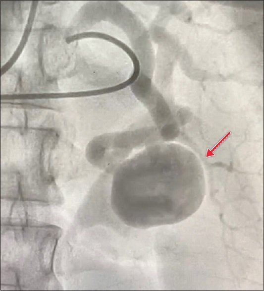 VSI journal IJVES (@vsijournalijves) on Twitter photo 📢 New Issue Alert! 🚀
The Indian Journal of Vascular and Endovascular Surgery (Jan-Mar 2025) is now live!
🔍 Explore the latest breakthroughs, clinical insights, and expert perspectives from 🇮🇳's vascular fraternity.
journals.lww.com/ijvs/pages/cur…
<a href="/wfvs/">jswf</a> <a href="/VascularForum/">Fórum Vascular</a> <a href="/VascularNews/">Vascular News</a> 📢 New Issue Alert! 🚀
The Indian Journal of Vascular and Endovascular Surgery (Jan-Mar 2025) is now live!
🔍 Explore the latest breakthroughs, clinical insights, and expert perspectives from 🇮🇳's vascular fraternity.
journals.lww.com/ijvs/pages/cur…
<a href="/wfvs/">jswf</a> <a href="/VascularForum/">Fórum Vascular</a> <a href="/VascularNews/">Vascular News</a>