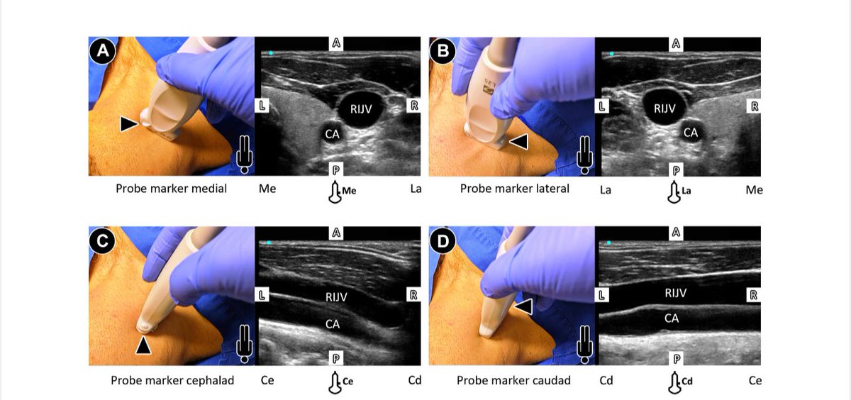 EmergPOCUS's tweet photo. 📌 ¿Hacia dónde va la marca del transductor a la hora de puncionar?       
           ¡Aclaremos la duda! 🏥🫠

Siempre surge la pregunta en accesos vasculares ecoguiados: ¿Dónde debe ir la marca del transductor? 🤔 En este paper, la American Society of Echocardiography nos responde esa y muchas más dudas.

🍏 Pues NO hay una convención universal sobre la orientación del marcador del transductor en acceso vascular.

🍏 La imagen en pantalla sigue la convención médica general ósea el marcador se muestra en el lado izquierdo de la pantalla 📺🔵.

🍏 Dependiendo de la orientación del transductor, las estructuras pueden aparecer en lados diferentes 🩸ojo checa la imagen.

📌 Para confirmar la orientación, intenta:
🍏 Movimientos laterales del transductor ↔️
🍏 Deslizar un dedo bajo un lado del transductor ☝️no falla
🍏 Aumentar presión en un lado y observar el cambio en la imagen 📉

🫨 ¡Te invito a revisar este paper y despejar todas las dudas y mitos sobre el acceso vascular ecoguiado! 💉📑