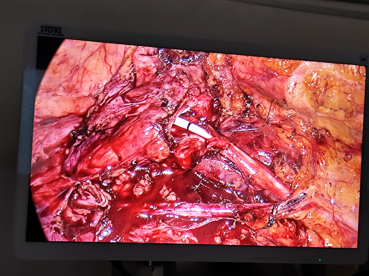 Antonio Andrea Grosso (@grossoanton) on Twitter photo Today the First laparoscopic pyeloplasty (redo case) has been performed in Ruanda at the King Faisal Hospital in Kigali. Happy to share knowledge and expertise to increase the quality of care
<a href="/minerviniandre/">Andrea Minervini</a> @rino_oriti <a href="/andrea_cocci/">Andrea Cocci</a> <a href="/FraSessa88/">Francesco Sessa,MD,PhD, FEBU</a> <a href="/SIU_Italia/">Società Italiana di Urologia</a> @welnessmanfoundation Today the First laparoscopic pyeloplasty (redo case) has been performed in Ruanda at the King Faisal Hospital in Kigali. Happy to share knowledge and expertise to increase the quality of care
<a href="/minerviniandre/">Andrea Minervini</a> @rino_oriti <a href="/andrea_cocci/">Andrea Cocci</a> <a href="/FraSessa88/">Francesco Sessa,MD,PhD, FEBU</a> <a href="/SIU_Italia/">Società Italiana di Urologia</a> @welnessmanfoundation