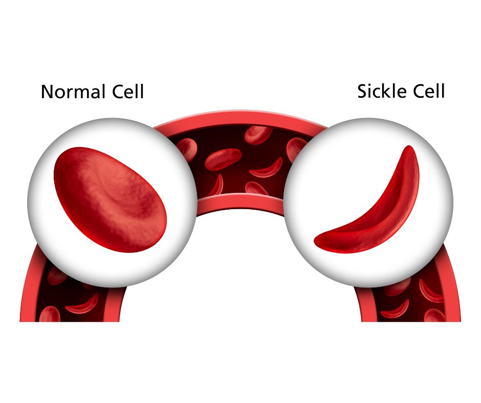 University Hospital Southampton 💙 (@uhsft) on Twitter photo Sickle cell disease affects the shape and function of red blood cells, causing pain and complications.
Red cell exchange transfusions help prevent painful crisis episodes. The new machine, funded by <a href="/NHSEngland/">NHS England</a>, makes treatment more efficient and reduces admissions. 🏥
(3/3) Sickle cell disease affects the shape and function of red blood cells, causing pain and complications.
Red cell exchange transfusions help prevent painful crisis episodes. The new machine, funded by <a href="/NHSEngland/">NHS England</a>, makes treatment more efficient and reduces admissions. 🏥
(3/3)