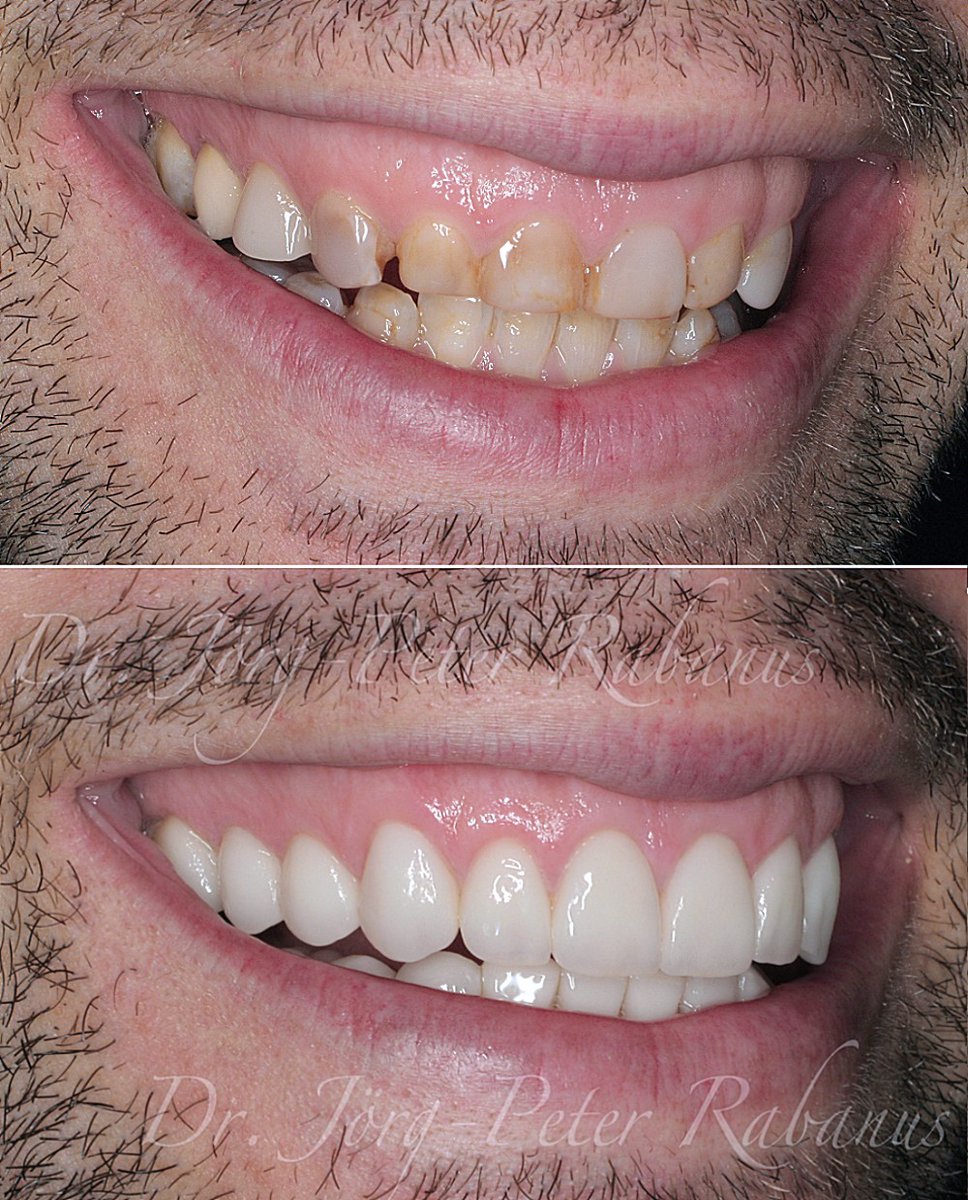PeterRabanus's tweet photo. Smile makeovers require more than just the placement of porcelain veneers. The mouth is a highly functional environment. Teeth are intimately engaged with the neuromuscular masticatory system. Natural teeth are designed by nature to efficiently distribute the heavy forces they encounter when chewing food.
Everybody is focussed on the aesthetic appearance of their face and smile. A youthful smile represents health and playfulness. Yet, a cosmetic dentist needs to go beyond that to create smiles that are both beautiful and fully functional. This guarantees that a smile is not only "pretty," but also confortable and durable.
https://t.co/mPROO56R5i
#smilemakeover
#cosmeticdentist
#porcelainveneers
#SanFrancisco