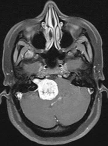 evanluthermd's tweet image. Surgical outcomes are, in part, linked to institutional volume. With acoustic neuromas, patients benefit from treatment at centers of excellence with experts in their field. Thank you again @iramsay34 for all your incredible work! #skullbase #cerebrovascular #acousticneuroma #IAC