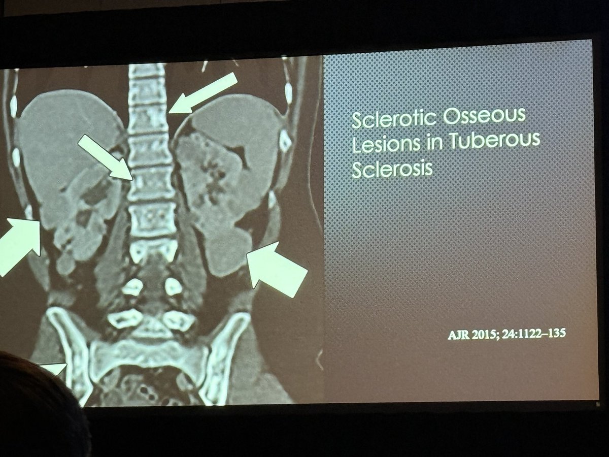 American Society of Spine Radiology (ASSR) (@the_assr) on Twitter photo Dr. Benita Tamrazi continues the Pediatric Imaging session at #ASSR25 with Neurophakomatoses
<a href="/RoyRiascosMD/">Roy Riascos MD, MBA, FACR</a> <a href="/LeviChazen/">J. Levi Chazen MD</a> Dr. Benita Tamrazi continues the Pediatric Imaging session at #ASSR25 with Neurophakomatoses
<a href="/RoyRiascosMD/">Roy Riascos MD, MBA, FACR</a> <a href="/LeviChazen/">J. Levi Chazen MD</a>