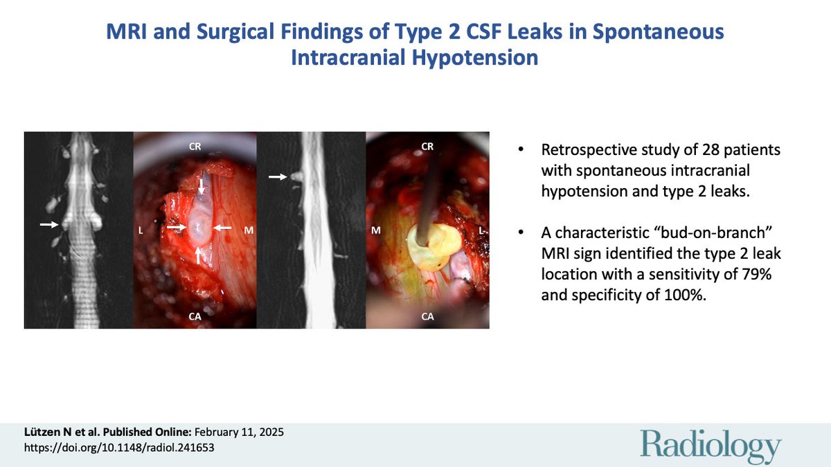 @RadiologyEditor (@radiologyeditor) on Twitter photo Type 2 spinal cerebrospinal fluid leaks in spontaneous intracranial hypotension occur after lateral dural tears, with arachnoid herniation visible on MRI. A closer look! <a href="/Niklas_Luetzen/">Niklas Lützen</a> <a href="/JrgenBeck/">Jürgen Beck</a> <a href="/NeuroradLal/">Lalani Carlton Jones</a> <a href="/ZanderCharlotte/">Charlotte Zander</a> <a href="/KathaDCwolf/">Katharina Wolf</a>
pubs.rsna.org/doi/10.1148/ra… Type 2 spinal cerebrospinal fluid leaks in spontaneous intracranial hypotension occur after lateral dural tears, with arachnoid herniation visible on MRI. A closer look! <a href="/Niklas_Luetzen/">Niklas Lützen</a> <a href="/JrgenBeck/">Jürgen Beck</a> <a href="/NeuroradLal/">Lalani Carlton Jones</a> <a href="/ZanderCharlotte/">Charlotte Zander</a> <a href="/KathaDCwolf/">Katharina Wolf</a>
pubs.rsna.org/doi/10.1148/ra…