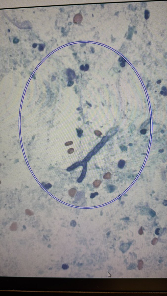 Mauro Saieg, MD, PhD, FIAC (@maurosaieg) on Twitter photo Aspergillus (with its characteristic 45 degree branching) in a bronchial washing. Cytology rules ! <a href="/mdlozanoe/">Lola Lozano</a> <a href="/tlabiano/">Tania Labiano</a> @Sincita_Roy <a href="/Sara_Jiang/">Xiaoyin "Sara" Jiang, MD (She/Her)</a> Aspergillus (with its characteristic 45 degree branching) in a bronchial washing. Cytology rules ! <a href="/mdlozanoe/">Lola Lozano</a> <a href="/tlabiano/">Tania Labiano</a> @Sincita_Roy <a href="/Sara_Jiang/">Xiaoyin "Sara" Jiang, MD (She/Her)</a>