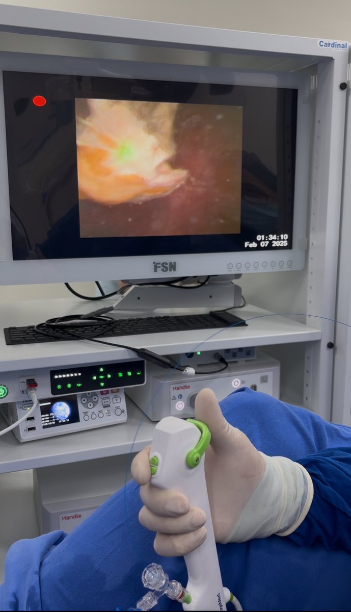 7.5Fr scope for narrow ureters 
No Sheath ✔️ 
Good image ✔️ 
Easy to navigate up ✔️ 
Good irrigation ✔️ 
Plug and play 🔌 
Light weight 🪶 
Disposable 🗑️
<a href="/ShenzhenHugeMed/">Shenzhen HugeMed</a> 
<a href="/so_uro/">UroSoMe</a>