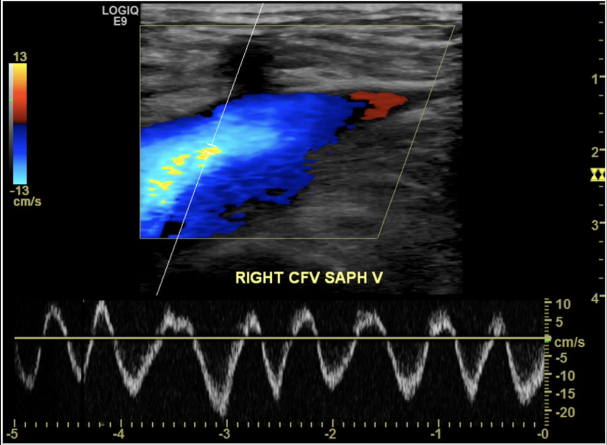 Kiran Rikhraj (@kiranrikhraj) on Twitter photo 1/5 What’s all the buzz about femoral vein doppler?
A recent paper (PMID: 37165284) by <a href="/drvimalzenICU/">Vimal Bhardwaj</a> and <a href="/ThinkingCC/">Philippe Rola</a> showed that femoral vein doppler had good accuracy in detecting venous congestion and moderately correlated with #VEXUS scores 1/5 What’s all the buzz about femoral vein doppler?
A recent paper (PMID: 37165284) by <a href="/drvimalzenICU/">Vimal Bhardwaj</a> and <a href="/ThinkingCC/">Philippe Rola</a> showed that femoral vein doppler had good accuracy in detecting venous congestion and moderately correlated with #VEXUS scores