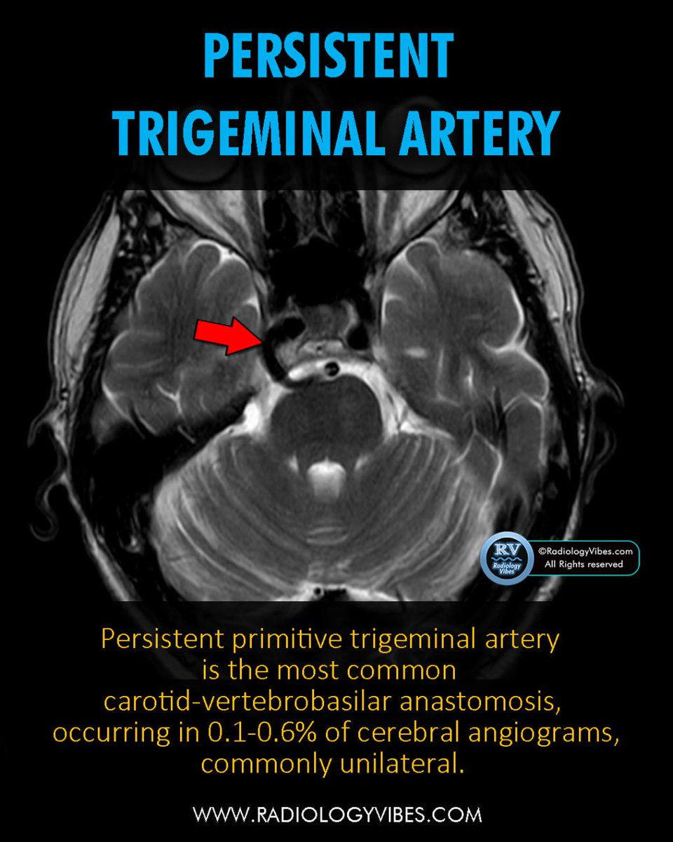 Persistent Primitive Trigeminal Artery (PPTA) : The most common carotid-vertebrobasilar anastomosis, seen in 0.1-0.6% of cerebral angiograms, usually unilateral. 
🔍 Recognizing PPTA is crucial in neuroimaging to avoid misinterpretation and plan interventions accordingly.  
#rad