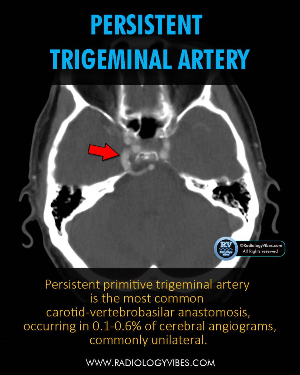 Persistent Primitive Trigeminal Artery (PPTA) : The most common carotid-vertebrobasilar anastomosis, seen in 0.1-0.6% of cerebral angiograms, usually unilateral. 
🔍 Recognizing PPTA is crucial in neuroimaging to avoid misinterpretation and plan interventions accordingly.