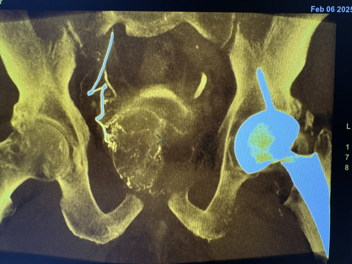 Charles Nutting, DO FSIR (@ir_nutt) on Twitter photo Asymmetric perfusion of the prostate is not uncommon. 75% of this gland was supplied by the type 1 origin off the umbilical artery Asymmetric perfusion of the prostate is not uncommon. 75% of this gland was supplied by the type 1 origin off the umbilical artery