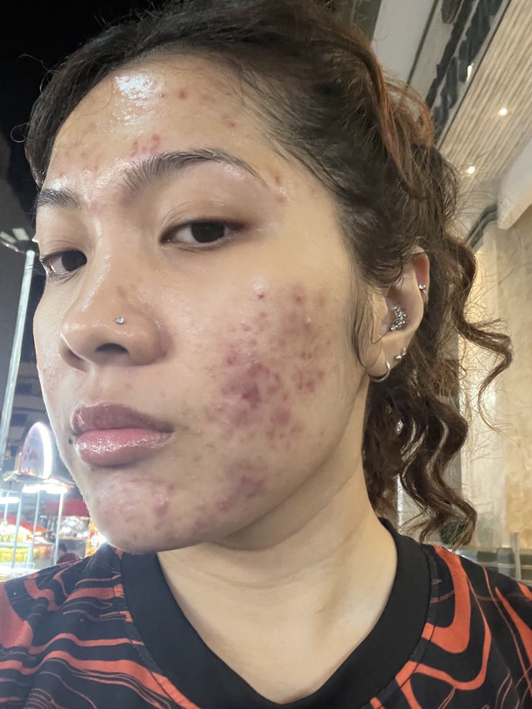 yanaazmill's tweet photo. Hormonal acne sucks, but I did it! I managed to clear my skin within a year🫶🏻

What I did was mostly live a healthier lifestyle + change my eating habit. https://t.co/whFggCi4su