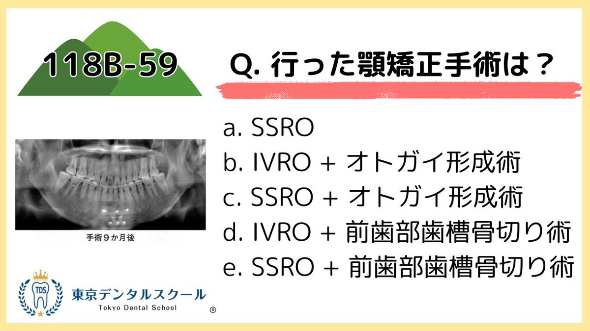 medicalboss2's tweet photo. 顎矯正手術　SSROとIVRO の見分け方を徹底解説！　
118回歯科国試出題！　東京デンタルスクール

https://t.co/rzxIWSO9dy

#顎矯正手術
#歯科矯正
#矯正歯科
#118回歯科医師国家試験
#119回歯科医師国家試験
#歯科医師国家試験
#IVRO https://t.co/qbpVf3qhcW