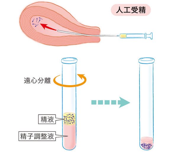 年后开工：湖南le情侣，双方都30+，想要孩子，又不想领养，但也无法接受自然受孕（要插入）。元宵节前后其中一位排卵显示强阳，最后用人工授精（AIH）注射受孕。

ps.交流的时候得知双方都想怀孕，le不是分T和P吗？？不是很懂这种想法
pps.请勿模仿，宫颈很脆弱的！