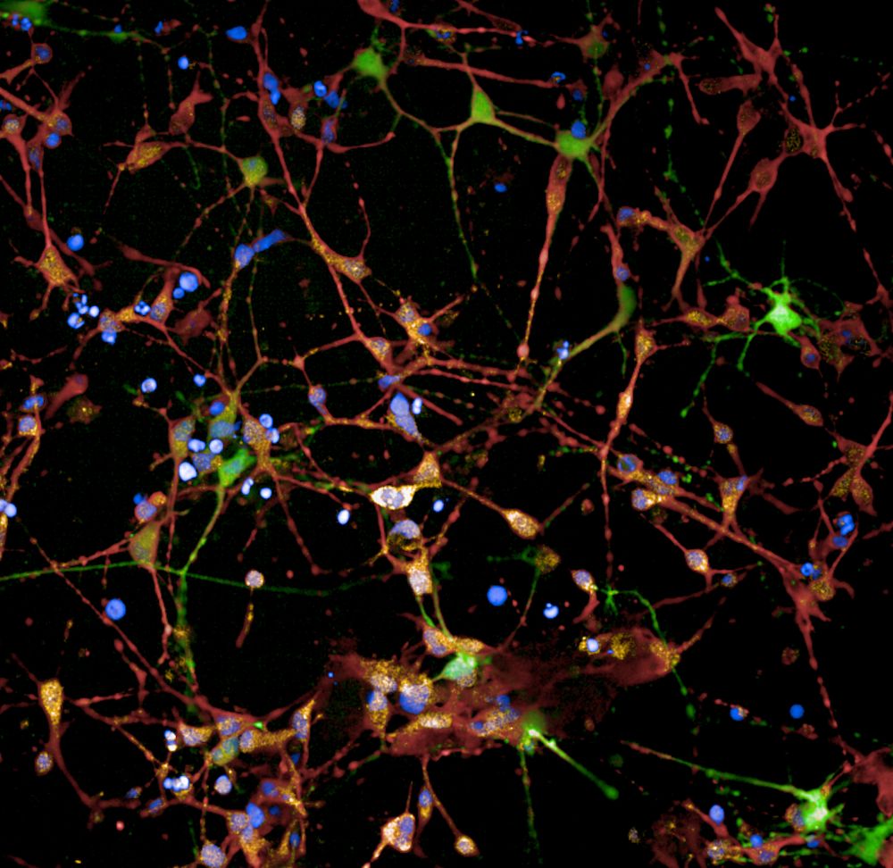 UK Dementia Research Institute (@ukdri) on Twitter photo A new study led by Prof Sarah Tabrizi (UK DRI at <a href="/UCLIoN/">UCL Queen Square Institute of Neurology</a> & <a href="/UCLHD/">UCL Huntington’s Disease Centre</a>) with <a href="/GabrielBalmus/">Gabriel Balmus</a> has taken major steps forward in advancing genetic therapies for Huntington's👏
The research lays an important foundation for future clinical trials👉buff.ly/4aVcMsN A new study led by Prof Sarah Tabrizi (UK DRI at <a href="/UCLIoN/">UCL Queen Square Institute of Neurology</a> & <a href="/UCLHD/">UCL Huntington’s Disease Centre</a>) with <a href="/GabrielBalmus/">Gabriel Balmus</a> has taken major steps forward in advancing genetic therapies for Huntington's👏
The research lays an important foundation for future clinical trials👉buff.ly/4aVcMsN