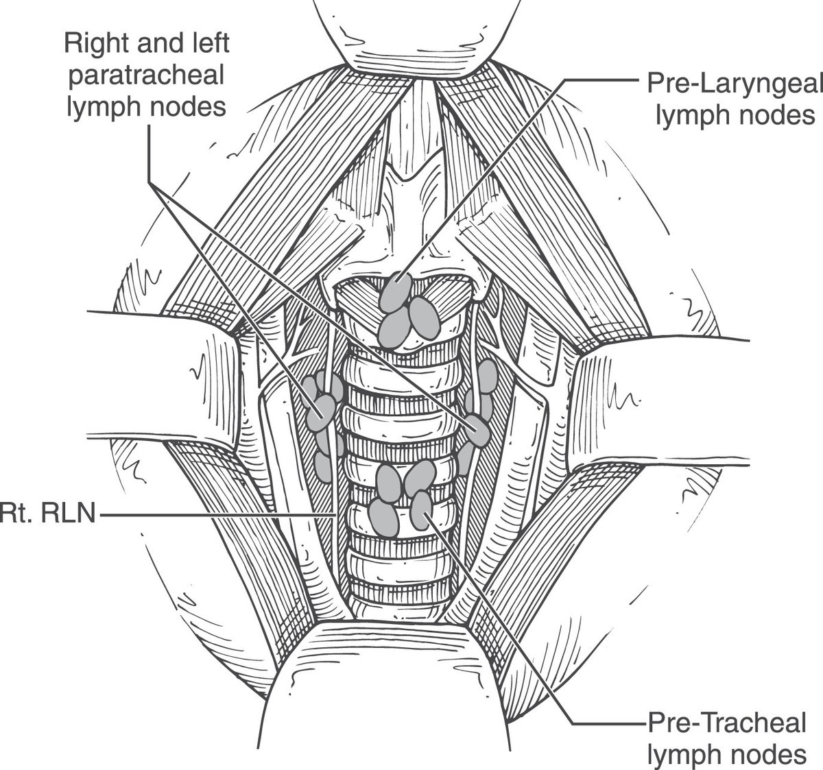 OperativeTechn1's tweet image. Download full text: Central neck dissection: updates on indications and surgical technique.  optecoto.com/article/S1043-… by V Xu, B Renslo, and E Cottrill @sciencedirect @AHNSinfo @AHNSEndo @Jefferson_OTO  #thyroidcancer #thyroid @AAOHNS @ElsevierConnect