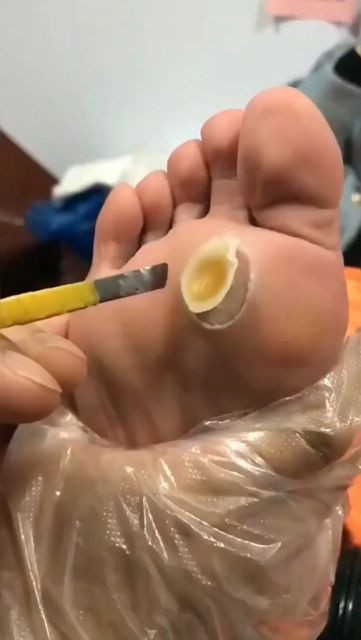 Swahilimedics's tweet photo. 🧷🧷🧷

Niliambiwa nitie guu kwenye biashara… nikaelewa vibaya! 🦶💼😂 #Footpreneur https://t.co/r9vl29IjGK