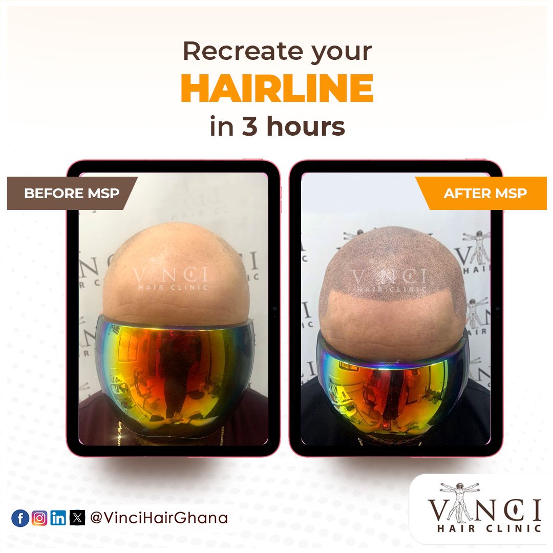 VinciHairGhana's tweet image. You can get your hairline recreated in 3 hours!

If you&apos;re suffering extensive hair loss, a #MicroScalpPigmentation might just be what you need. Book a FREE consultation at vincihairclinic.africa to get started

 #MSP #HairGoals  #VinciHairClinic #HairRestoration #HairTransplant
