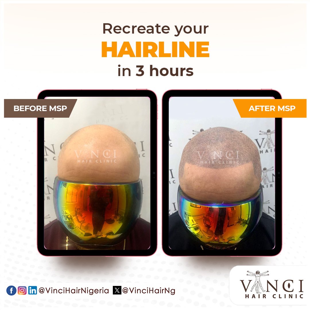 VinciHairNG's tweet image. You can get your hairline recreated in 3 hours!

If you&apos;re suffering extensive hair loss, a #MicroScalpPigmentation might just be what you need. Book a FREE consultation at vincihairclinic.africa to get started

 #MSP #HairGoals  #VinciHairClinic #HairRestoration #HairTransplant
