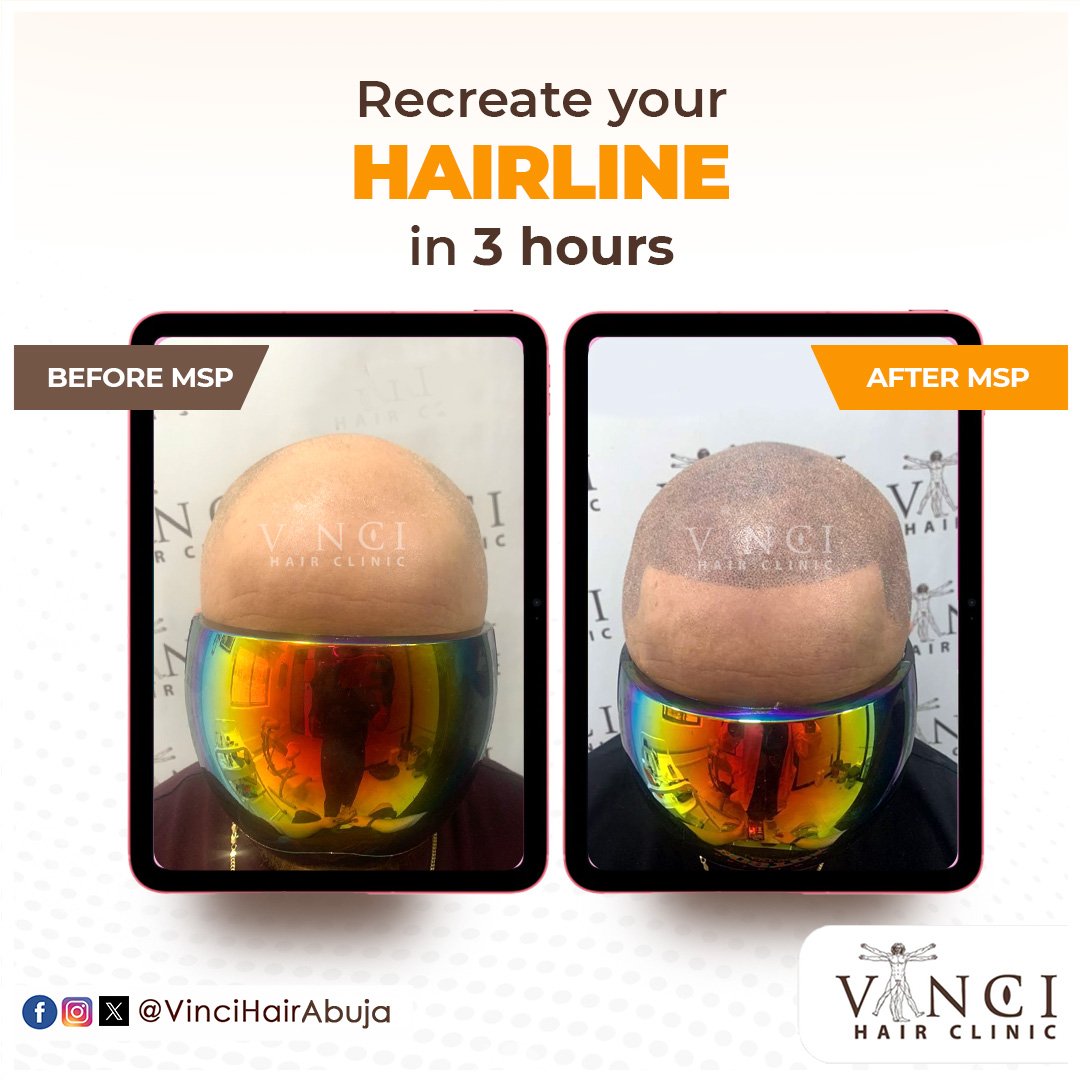 vincihairabuja's tweet image. You can get your hairline recreated in 3 hours!

If you&apos;re suffering extensive hair loss, a #MicroScalpPigmentation might just be what you need. Book a FREE consultation at vincihairclinic.africa to get started

 #MSP #HairGoals  #VinciHairClinic #HairRestoration #HairTransplant