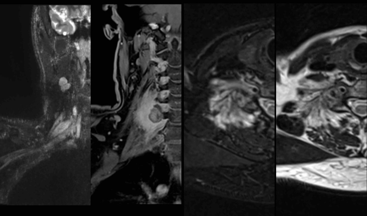 mehtanikhil's tweet image. 🧠 Spine Case Challenge: 
30-year-old male with right-sided neck pain, swelling, and upper limb numbness for 1 year.  

📌 MRI Brachial Plexus (Right) attached.

❓ What’s your next step?  Ddx?

Drop your thoughts below! ⬇️
#NeuroImaging #Radiology #BrachialPlexus #radres #MRI