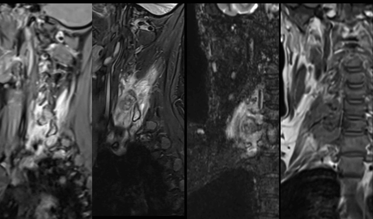 mehtanikhil's tweet image. 🧠 Spine Case Challenge: 
30-year-old male with right-sided neck pain, swelling, and upper limb numbness for 1 year.  

📌 MRI Brachial Plexus (Right) attached.

❓ What’s your next step?  Ddx?

Drop your thoughts below! ⬇️
#NeuroImaging #Radiology #BrachialPlexus #radres #MRI