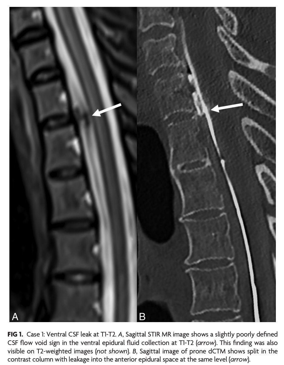 AJNR (@theajnr) on Twitter photo "“Flow Void Sign”: Flow Artifact on T2-Weighted MRI Can Be an Indicator of Dural Defect Location in Ventral Type 1 Spinal CSF Leaks"
doi.org/10.3174/ajnr.A…
<a href="/NeuroradLal/">Lalani Carlton Jones</a> #CSFLeak #FellowsJournalClub "“Flow Void Sign”: Flow Artifact on T2-Weighted MRI Can Be an Indicator of Dural Defect Location in Ventral Type 1 Spinal CSF Leaks"
doi.org/10.3174/ajnr.A…
<a href="/NeuroradLal/">Lalani Carlton Jones</a> #CSFLeak #FellowsJournalClub