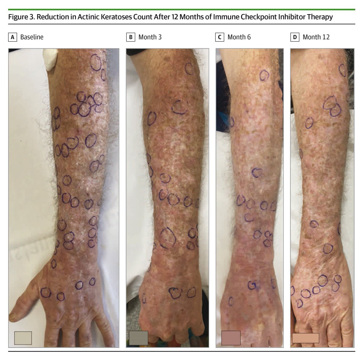 Immune checkpoint inhibitors reduced the number of actinic keratoses and keratinocyte carcinomas in patients. ja.ma/3CDFr9b