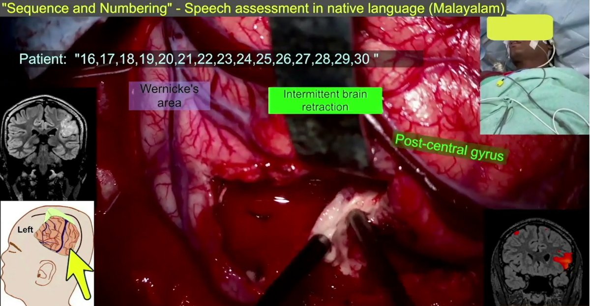 TheJNS's tweet photo. #OperativeVideo Hexamodal awake brain mapping (language, sensorimotor, ictal, visual, auditory) for multilobar resection in a dominant hemisphere parieto-fronto-temporo-occipital cortical malformation with drug-resistant epilepsy
https://t.co/1ISdvbFkjr https://t.co/G7K2G537aC