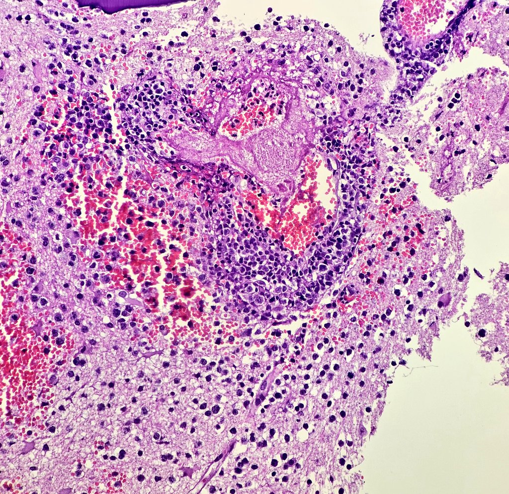 DrSultanClskn's tweet photo. Primary diffuse large B cell lymphoma of central nervous system with perivascular cuffing 🔬🧠  An exciting case because I do not encounter it frequently among my routine biopsies 😇
#pathology #pathresident #neuropath #hematopath #microscope #lymphoma https://t.co/bIRYGbKRV9