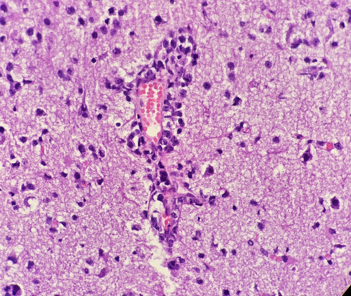 DrSultanClskn's tweet photo. Primary diffuse large B cell lymphoma of central nervous system with perivascular cuffing 🔬🧠  An exciting case because I do not encounter it frequently among my routine biopsies 😇
#pathology #pathresident #neuropath #hematopath #microscope #lymphoma https://t.co/bIRYGbKRV9