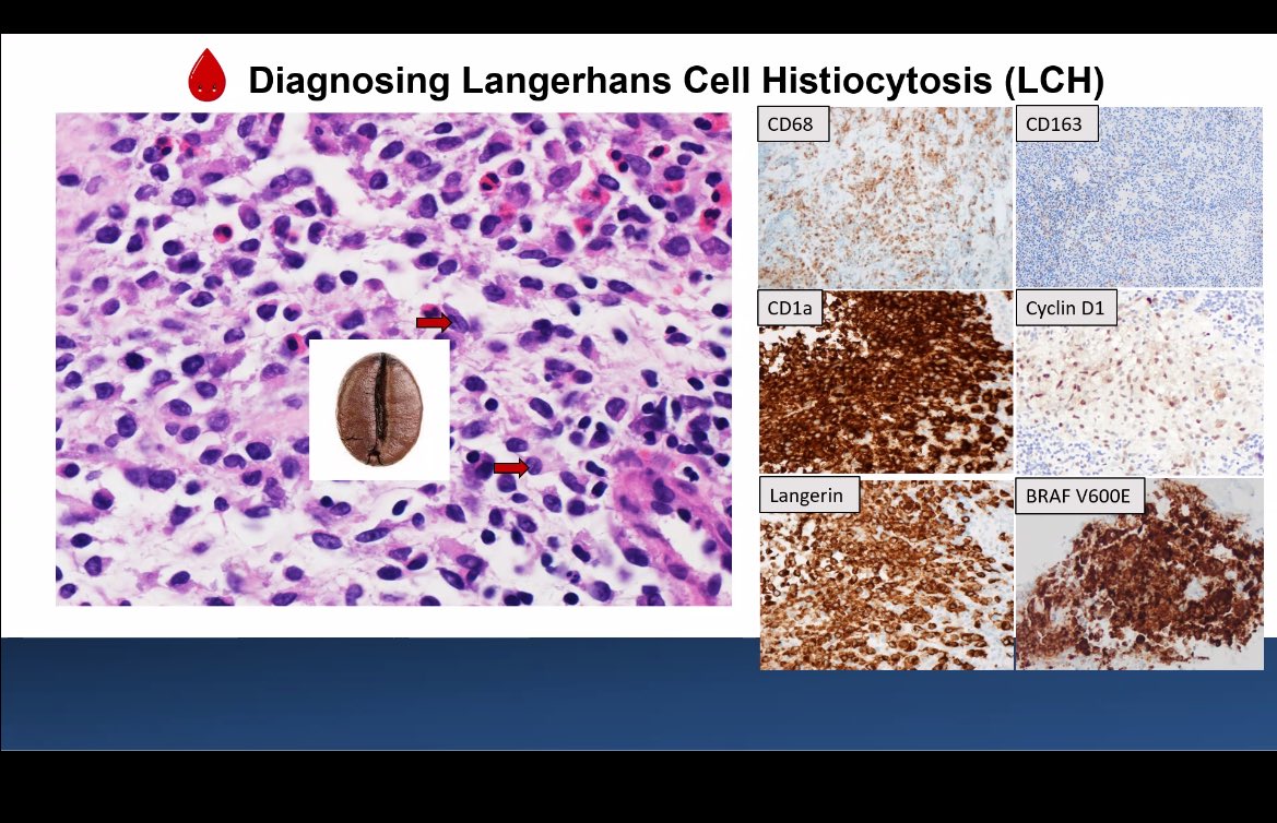Fantastic talk by <a href="/aravindranmd/">Aishwarya Ravindran, MD</a> on histiocytic neoplasms, their overlap with xanthogranulomatous lesions &amp; lymphoma, and the crucial role of NGS in diagnosis. Great job, Dr. Ravindran! #Pathology #NGS #HistiocyticNeoplasms #letstalkhistiocytosis