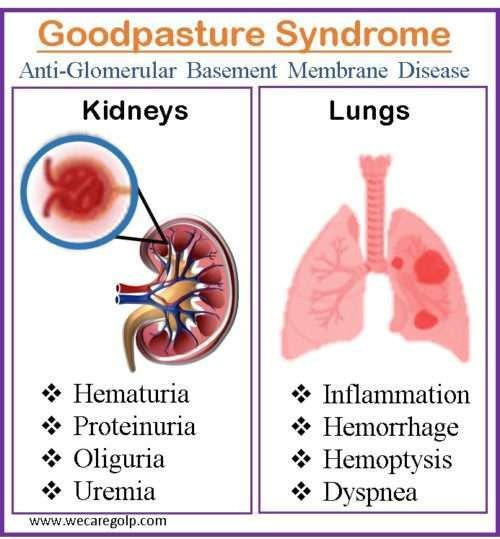 Goodpasture syndrome
also known as anti–glomerular basement membrane disease, is a rare autoimmune disease in which antibodies attack the basement membrane in lungs and kidneys, leading to bleeding from the lungs, glomerulonephritis, and kidney failure......