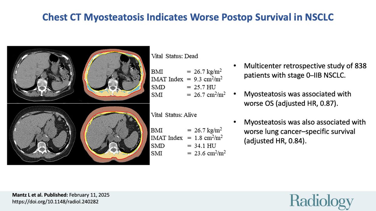 @RadiologyEditor (@radiologyeditor) on Twitter photo Preoperative chest CT myosteatosis markers were linked to worse survival after resection of stage 0–IIB non–small cell lung cancer, regardless of skeletal muscle index or subcutaneous adipose tissue. 🫀 <a href="/F_Fintelmann_MD/">Florian J. Fintelmann</a> <a href="/MGHImaging/">Mass General Imaging</a> <a href="/jonherochung/">Jonathan Chung, MD</a>
pubs.rsna.org/doi/10.1148/ra… Preoperative chest CT myosteatosis markers were linked to worse survival after resection of stage 0–IIB non–small cell lung cancer, regardless of skeletal muscle index or subcutaneous adipose tissue. 🫀 <a href="/F_Fintelmann_MD/">Florian J. Fintelmann</a> <a href="/MGHImaging/">Mass General Imaging</a> <a href="/jonherochung/">Jonathan Chung, MD</a>
pubs.rsna.org/doi/10.1148/ra…