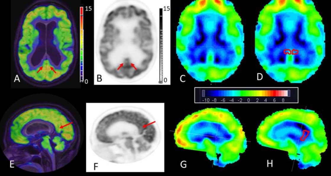 WCM Molecular Imaging and Therapeutics (@molecularwcm) on Twitter photo New publication from our division! 🚨Congrats to <a href="/AndresRicaurte1/">Andres Ricaurte Fajardo</a> and <a href="/jana_ivanidze/">Jana Ivanidze</a> for leading this exciting work alongside a world-class team of physicians with @JOsbMD <a href="/GloriaChiangMD/">Gloria Chiang, MD</a> <a href="/AnnaNordvig/">Anna Nordvig MD</a> <a href="/SamanthaKeilPhD/">Samantha Keil, PhD</a> published at <a href="/TheAJNR/">AJNR</a>.
<a href="/WCMRadiology/">Weill Cornell Medicine Radiology</a> <a href="/WCMCNeurology/">Weill Cornell Neurology</a> New publication from our division! 🚨Congrats to <a href="/AndresRicaurte1/">Andres Ricaurte Fajardo</a> and <a href="/jana_ivanidze/">Jana Ivanidze</a> for leading this exciting work alongside a world-class team of physicians with @JOsbMD <a href="/GloriaChiangMD/">Gloria Chiang, MD</a> <a href="/AnnaNordvig/">Anna Nordvig MD</a> <a href="/SamanthaKeilPhD/">Samantha Keil, PhD</a> published at <a href="/TheAJNR/">AJNR</a>.
<a href="/WCMRadiology/">Weill Cornell Medicine Radiology</a> <a href="/WCMCNeurology/">Weill Cornell Neurology</a>